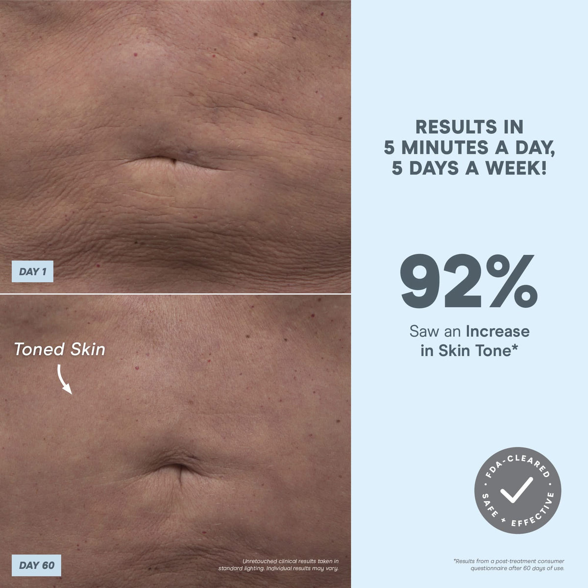 NuBODY – Skin Toning Microcurrent Device for Body | NuFACE