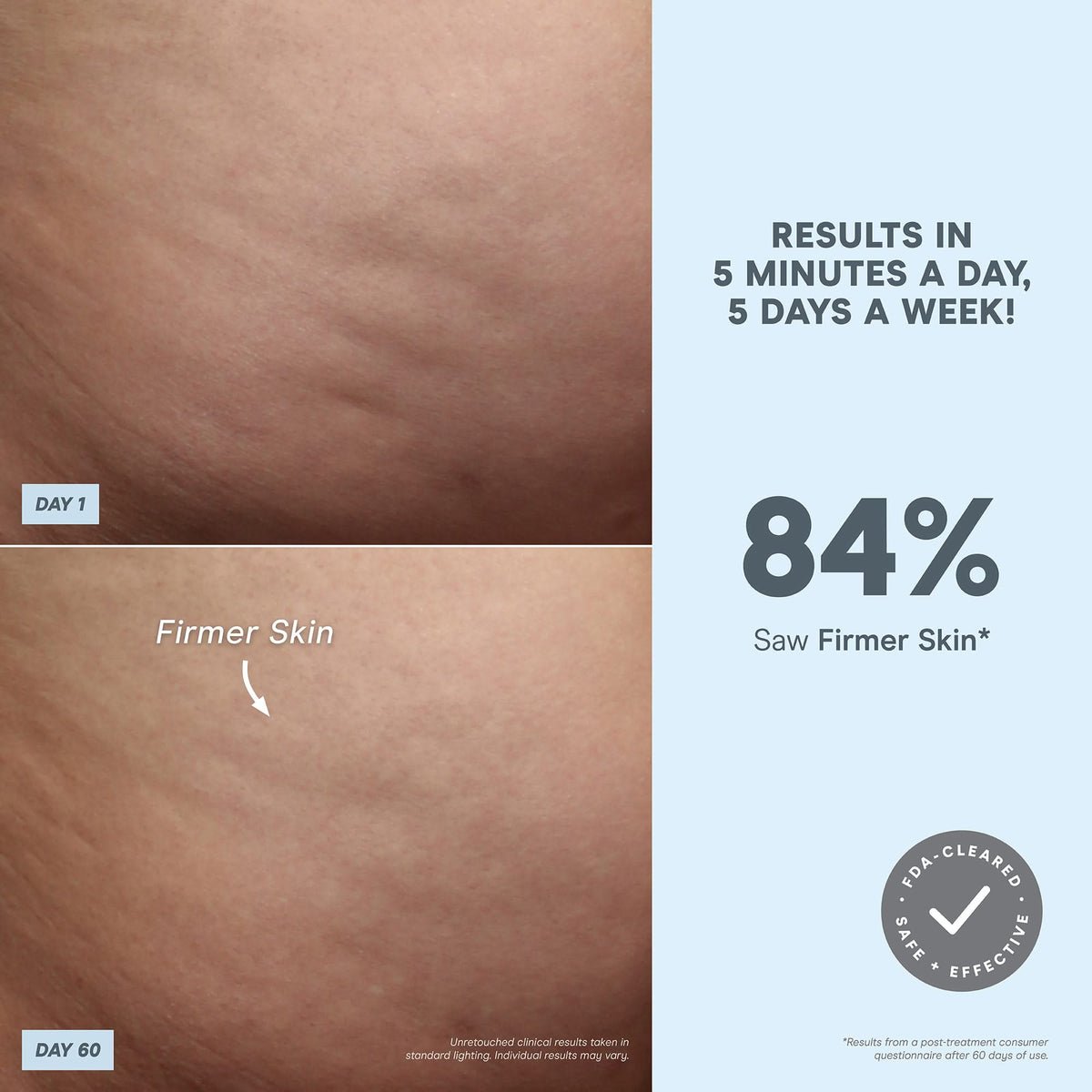 NuBODY – Skin Toning Microcurrent Device for Body | NuFACE