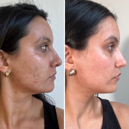 CurrentBody Skin Masque LED lumière bleue: Série 2