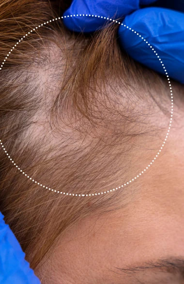 FAQ™ 301 | Appareil à LED rouge pour la repousse des cheveux