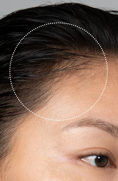 FOREO LUNA™ 4 hair | Red Light Therapy Hair Growth