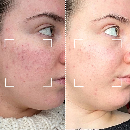 CurrentBody Skin Masque LED lumière bleue: Série 2