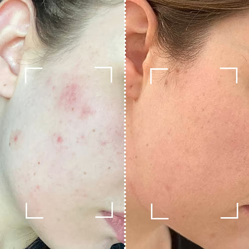 CurrentBody Skin Masque LED lumière bleue: Série 2