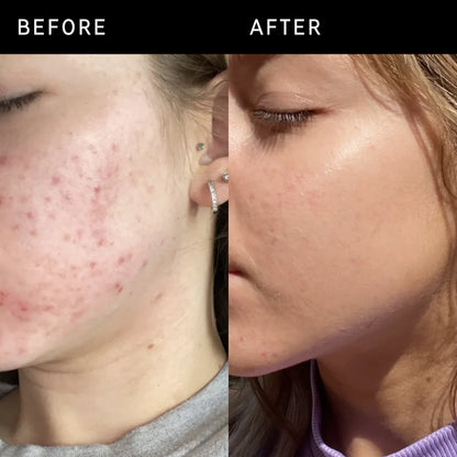 ANUA - Niacinamide 10% + TXA 4% Dark Spot Correcting Serum - 30ml