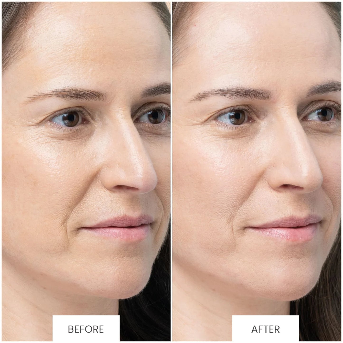 TriPollar Stop Vx 2 | NOUVELLE technologie Multi-RF (Radiofréquence) + DMA | Appareil facial à domicile