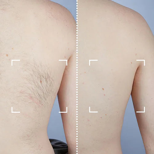 CurrentBody Skin Appareil d'épilation laser