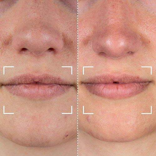 CurrentBody Skin LED Lip Perfector Appareil pour les lèvres