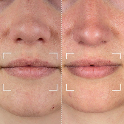 CurrentBody Skin LED Lip Perfector Appareil pour les lèvres