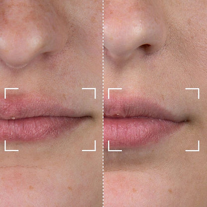 CurrentBody Skin LED Lip Perfector Appareil pour les lèvres