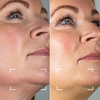 CurrentBody Skin RF Appareil radiofréquence visage