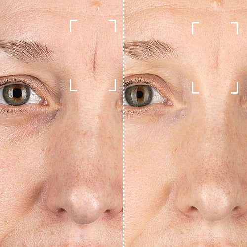 CurrentBody Skin RF Appareil radiofréquence visage