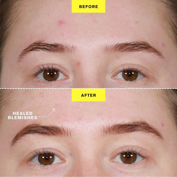 ZIIP DOT - Appareil de traitement contre les boutons par microcourant