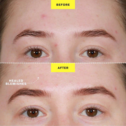 ZIIP DOT - Appareil de traitement contre les boutons par microcourant