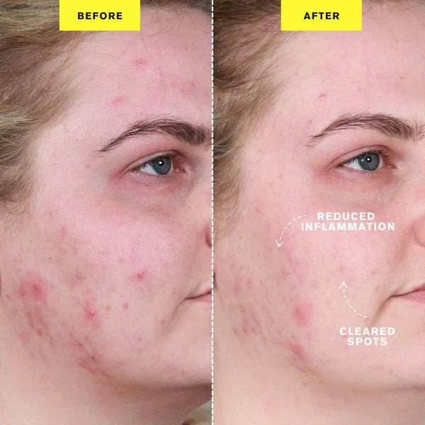 ZIIP DOT - Appareil de traitement contre les boutons par microcourant