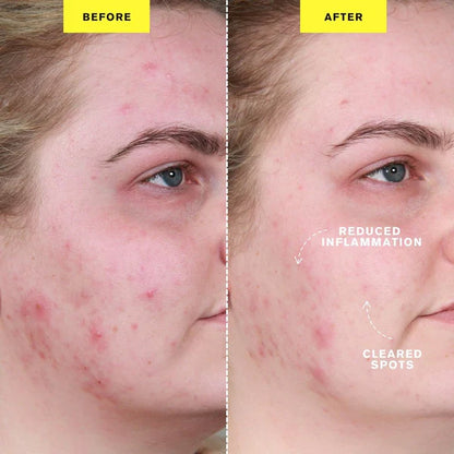 ZIIP DOT - Appareil de traitement contre les boutons par microcourant