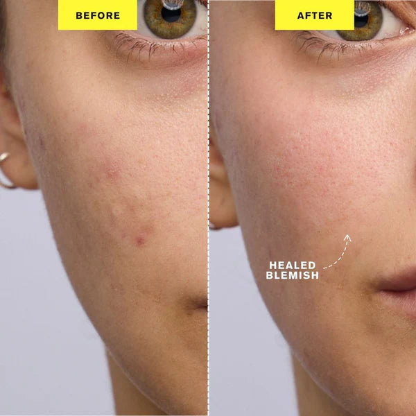 ZIIP DOT - Appareil de traitement contre les boutons par microcourant