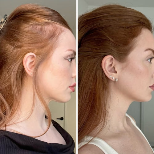 CurrentBody Skin Casque LED repousse cheveux