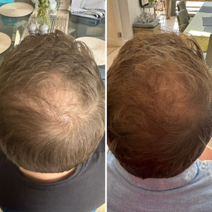 CurrentBody Skin Casque LED repousse cheveux